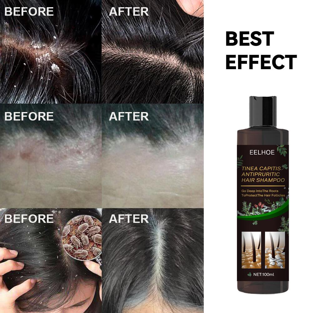 EELHOE Anti-Dandruff Shampoo Itch Relief