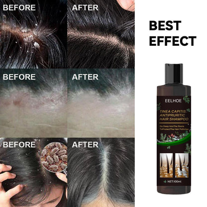 EELHOE Anti-Dandruff Shampoo Itch Relief